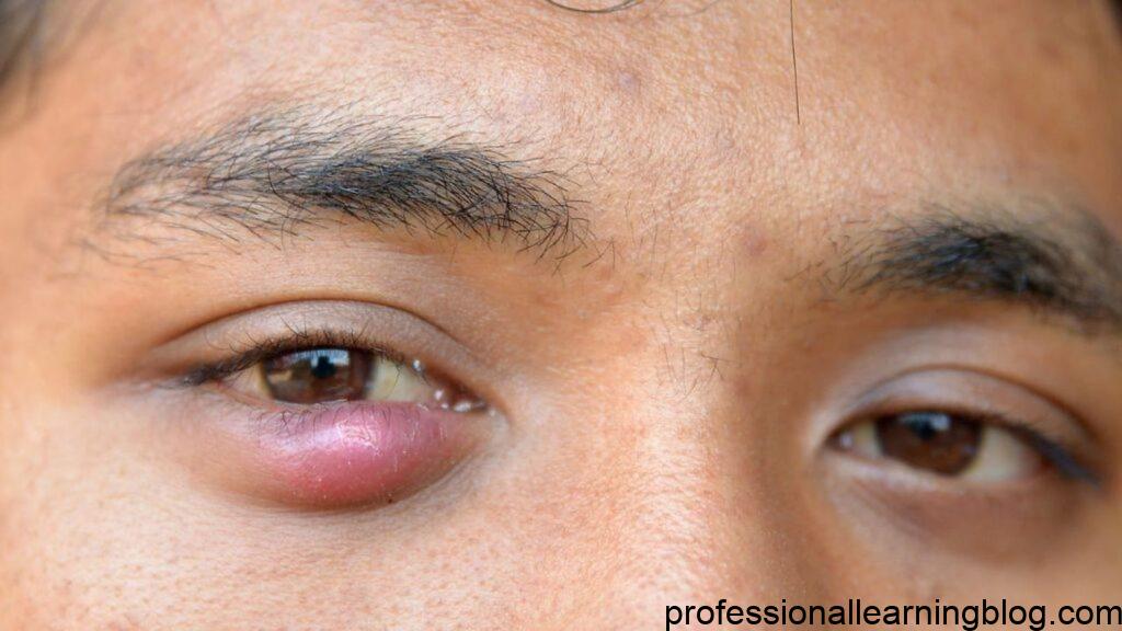 How do I prevent the pimple on my eyelid?